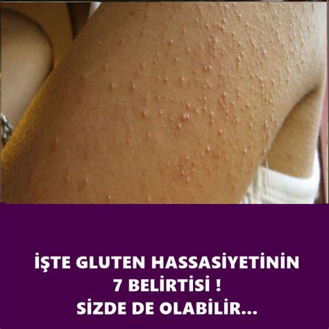 Gluten hassasiyeti belirtileri